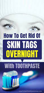 Type Of Skin Moles Healthy Medicine Tips In 2021 Diy Skin Tag Removal Skin Tag Removal Skin Tag On Eyelid