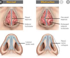 They usually occur in both the right and left nasal passages and can block the flow of air. Nose Sinus Ent