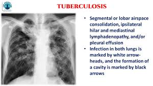 Image result for Chest XRay Interpretation