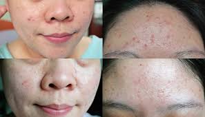 Kiehl's specialised products for acne prone skin are formulated to gently, yet effectively, care for skin while helping to clear blemishes, blackheads and whiteheads using scientifically proven ingredients. Kiehls Skin Care Reviews Nuevo Skincare