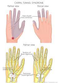 Pins And Needles And Carpal Tunnel Syndrome