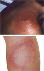 Image result for infected tick bite