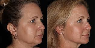 Eye bags, skin, hair, body, microneedling. Sagging Jowls And Double Chin Why Our Patients Love The Lumen Tight Procedure The Lumen Center