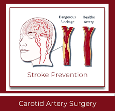 Image result for carotid artery