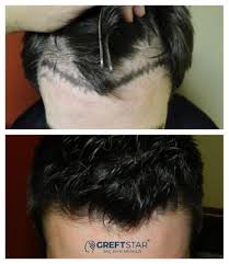 Greft Star Adli Kullanicinin Sac Ekimi Samsun Panosundaki Pin Sac