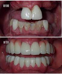 Welcome to puresmile dental care. Perfect Smile Dental In Tijuana Mexico Read 39 Reviews