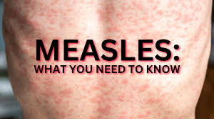 Image result for measles