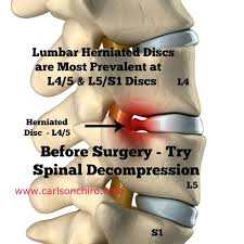 Pin On Austin Lower Back Pain
