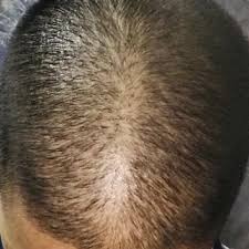 But the hair is still there, it's just miniaturized — thinner. Hi Gd Morning Actually Last Week Cut My Hair Like Short My Hair Is So Thin So Now My Head Line Showing So Weird Gap Is Showing How To Cover My