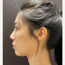 Top Chin Implant Doctors in New Hampshire, U.S.