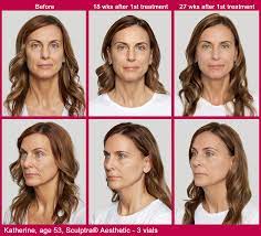 Sculptra aesthetic before and after image gallery. Fox Valley Plastic Surgery Sculptra Aesthetic