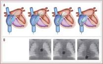 Image result for rashkind balloon atrial septostomy