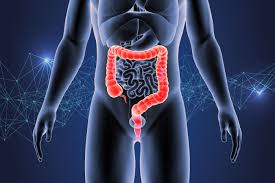 Image result for Colorectal Cancer