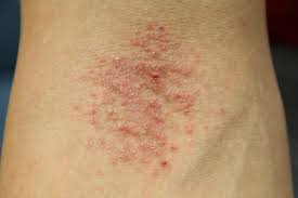 Many other names are used for in some cases, people tend to break out in a severe heat rash after spending time in the sun and particularly after using waterproof sunscreen products. Should I See A Dermatologist Or Allergist For My Rash Massachusetts Dermatology Associates