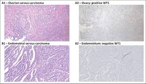 Learn more about ovarian cancer such as what causes it, how it is diagnosed, and available treatment options. Well Differentiated Papillary Mesothelioma With Two Synchronous Serous Gynaecologic Carcinomas In A 62 Year Old Woman Lessons Learned For The Gynaecologic Surgeon Journal Of Obstetrics And Gynaecology Canada