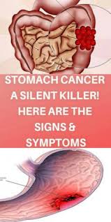 Stomach cancer symptoms can be easy to miss. Pin On Care Health