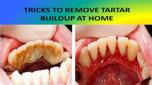 Tricks To Remove Tartar Buildup At Home Health Routine Health Disease Healthy Drinks