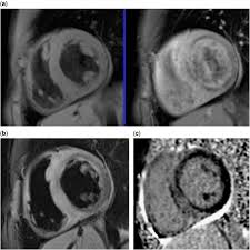 Autoimmune myocarditis and dilated cardiomyopathy: Utility Of Cardiac Mri In Paediatric Myocarditis Cardiology In The Young Cambridge Core