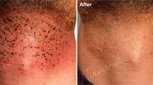 This is a temporary side effect and usually goes away on its own within a week in the meantime, you can do a lot to prevent the worst side effects of laser hair removal, by doing your research, and choosing a quality provider. Laser Hair Removal Side Effects Long Term