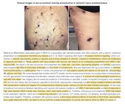 Lungs manifestations of system autoimmune diseases. Lupus Twitter Search