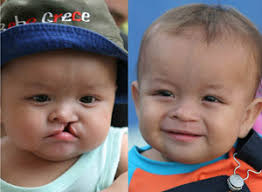 My Operation Smile Adventures