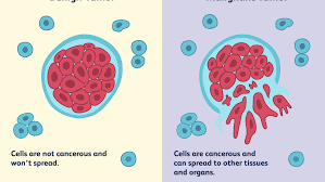 Benign Lung Tumors Types Characteristics And Treatment