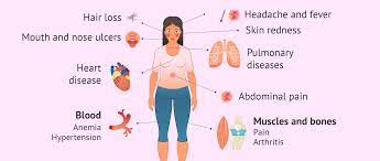 ¿qué es el lupus en las mujeres? Symptoms And Diseases Caused By Sle