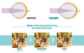 Image result for Myopia
