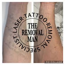 According to cynosure, developer of the picosure system and a publicly traded company, the average laser tattoo removal patients are college educated and between the ages of 24 and 39. The Removal Man Laser Tattoo Removal Specialist Facebook