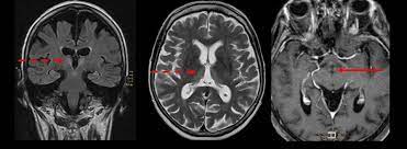 Chronic fatigue syndrom in community. Korsakow Syndrom Eref Thieme