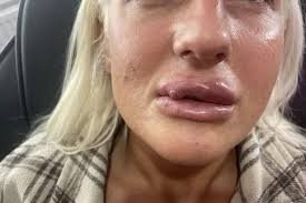 I was so addicted to face fillers my lips looked like a beak and started to  rot away'