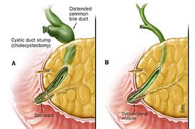 The sphincter of oddi is a muscular valve that opens and closes. Sphincter Of Oddi Dysfunction Johns Hopkins Medicine