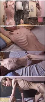 Fetish Skinny Shock Anorexia | Page 52 | Sex-Forum - All New Porn For Free,  Mydirtyhobby Porno Clips und Videos