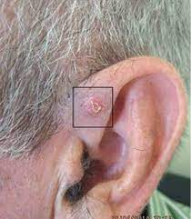 If you aren't sure which type of skin cancer. Racgp Management Of The Disappearing Skin Cancer