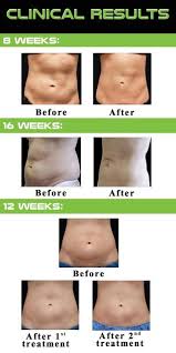 Take a quick quiz to receive your personalized keto diet plan. Cryolipolysis Get Your Slim Body Back In A Month Paperblog