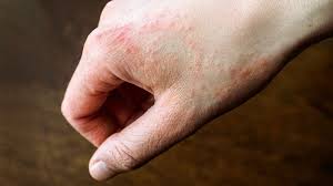 Rash is a symptom that causes the affected area of skin to turn red and blotchy and to swell. 8 Common Types Of Rashes Everyday Health