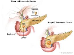 This is called a deep vein thrombosis or dvt. Early Pancreatic Cancer Biomarkers Uncovered