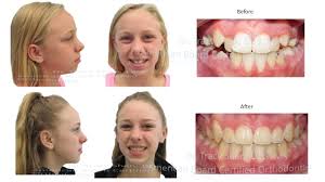 See our before and after braces photos here and join the 7,000 happy smiles transformed! Before And After Orthodontic Treatment Suncreek Orthodontics In Allen Texas Affordable Braces Invisalign