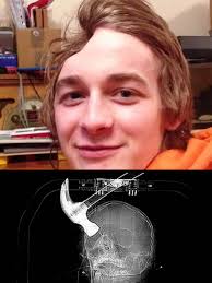 inspirational story of overcoming paralysis