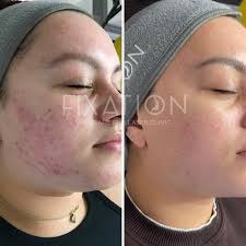 High Frequency Facial at Fixation Skincare in Sheffield