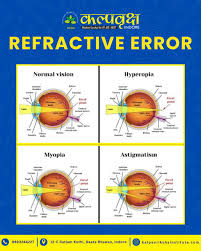 Image result for Refractive Error