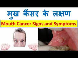 If you have symptoms that suggest oral cancer, the doctor or dentist checks your mouth and throat for red or white patches, lumps, swelling, or other surgery to remove the tumor in the mouth or throat is a common treatment for oral cancer. Mouth Cancer Symptoms In Hindi Youtube