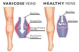 Best Compression Socks For Varicose Veins With Pictures
