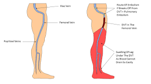 Effects of DVT in Leg – Mark Whiteley | Dr Morton's - the medical helpline