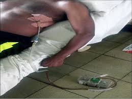 Image result for Small Caliber Chest Tube