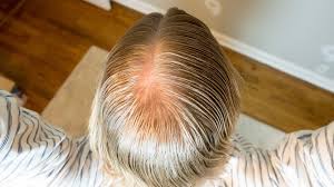 Learn the causes and types of one of the main causes of baldness is when the male hormone testosterone is converted to a form called eventually, the thinning hair at the front and top meet up, leaving only a ring of hair around the head. How To Handle Men S Thinning Hair Here Is What You Can Do About It Beardbrand