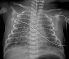 In real time, air can be seen moving through the bronchi, and this finding is known as a dynamic air bronchogram. Newborn Respiratory Disorders American Academy Of Pediatrics