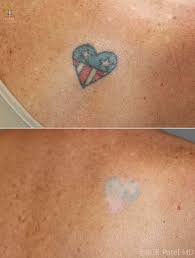 No matter the reason for your tattoo removal, beleza medspa can help. Laser Tattoo Removal Patel Plastic Surgery Bck Patel Md
