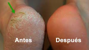 Resultado de imagen de Pies sin callos y durezas