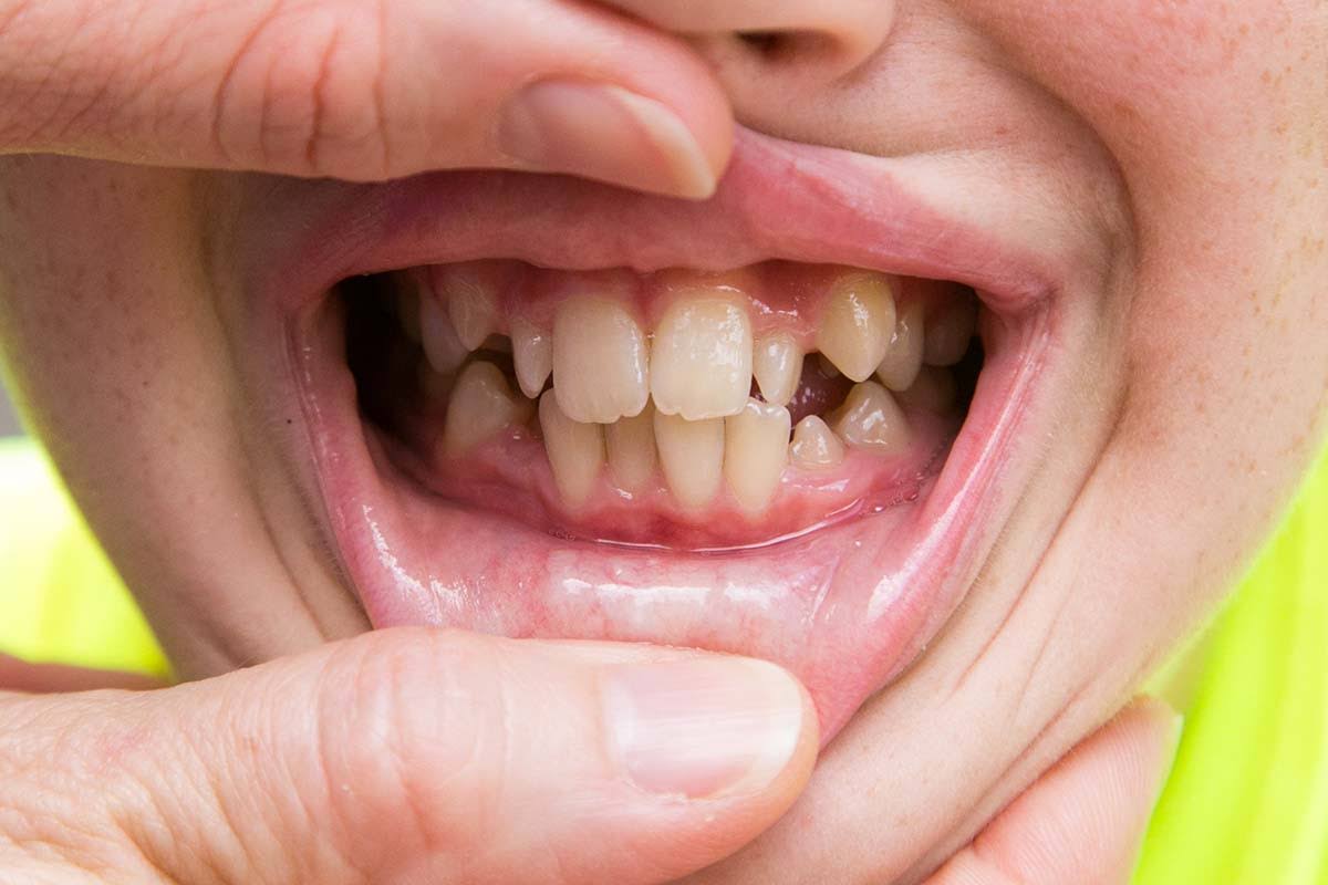 MALALIGNED TEETH product image